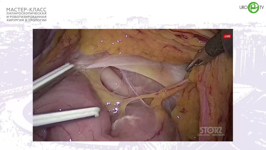 Сергеев В.П. - Лапароскопическая нефректомия тазоводистопированной почки. Лимфаденэкктомия