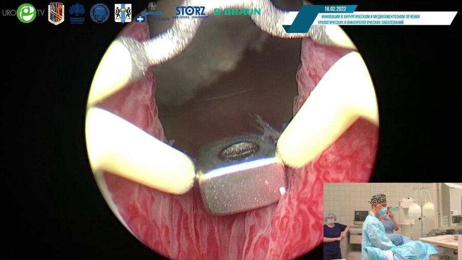 Нотов К.Г. - Трансуретральная биполярная энуклеация аденомы простаты
