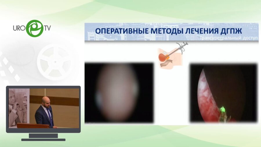 Камалов Д.М. - Трансперинеальная перкутанная лазерная абляция гиперплазии предстательной железы