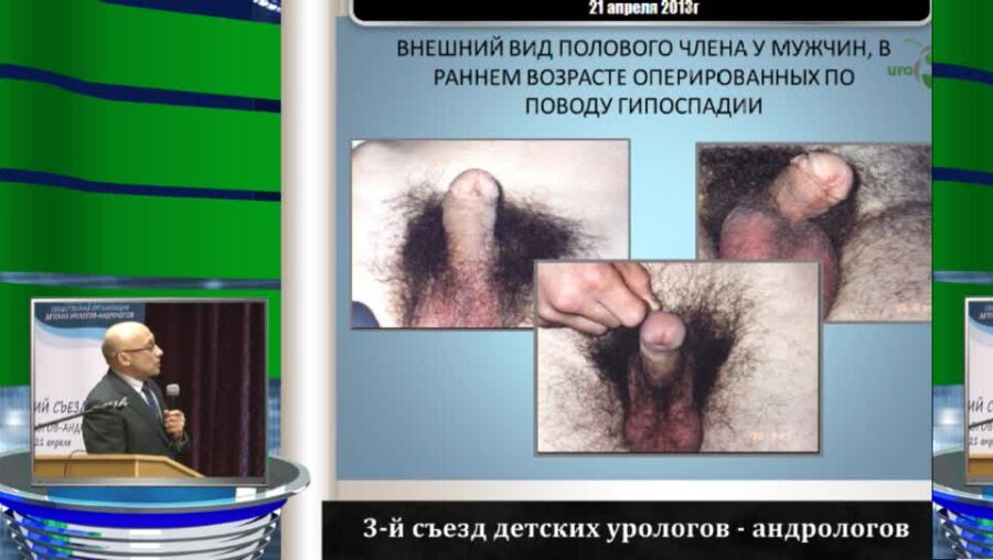 Староверов О.В. "Функционально-косметическое значение формирования головки полового члена у детей с гипоспадией"