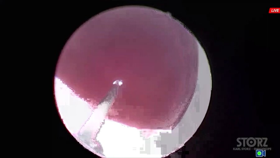 Сорокин Н.И. - Трансуретральная энуклеация простаты karl storz CALCULASE III