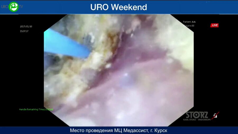 Сорокин Н.И. - Ретроградная гибкая интраренальная пиелолитотрипсия (Fiberlase U3, Innovex)