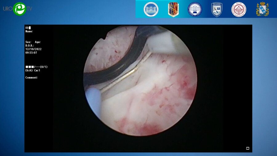 Севрюков Ф.А. - Трансуретральная биполярная плазменная энуклеация аденомы простаты (видеооперация)