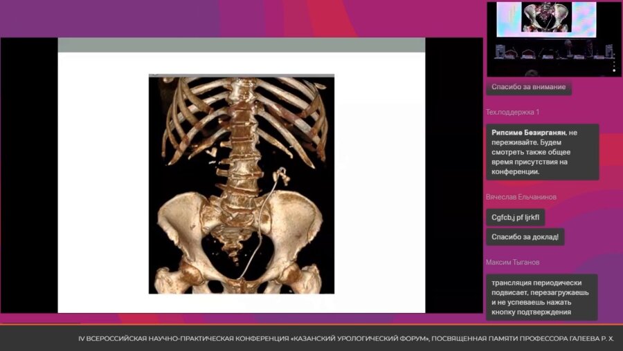 Операция 2. Саакян А.А. - ПЕРК (перкутанная нефролитолапаксия)