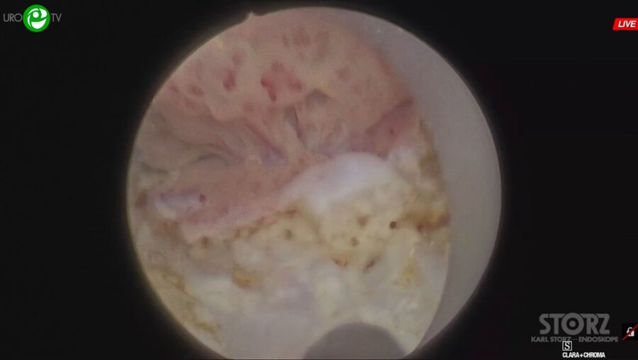 Дымов А.М. - Низкомощная энуклеация гиперплазии простаты, лазерная резекция мочевого пузыря EN BLOC