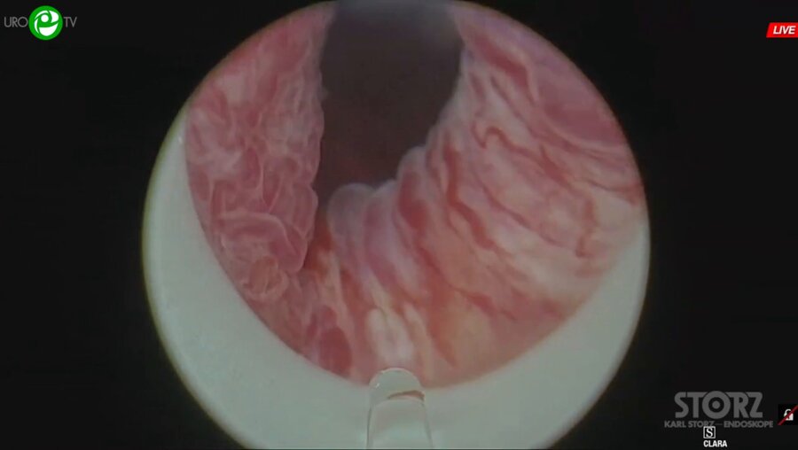 Сорокин Н.И. - Низкомощная энуклеация гиперплазии простаты, цистолитотрипсия