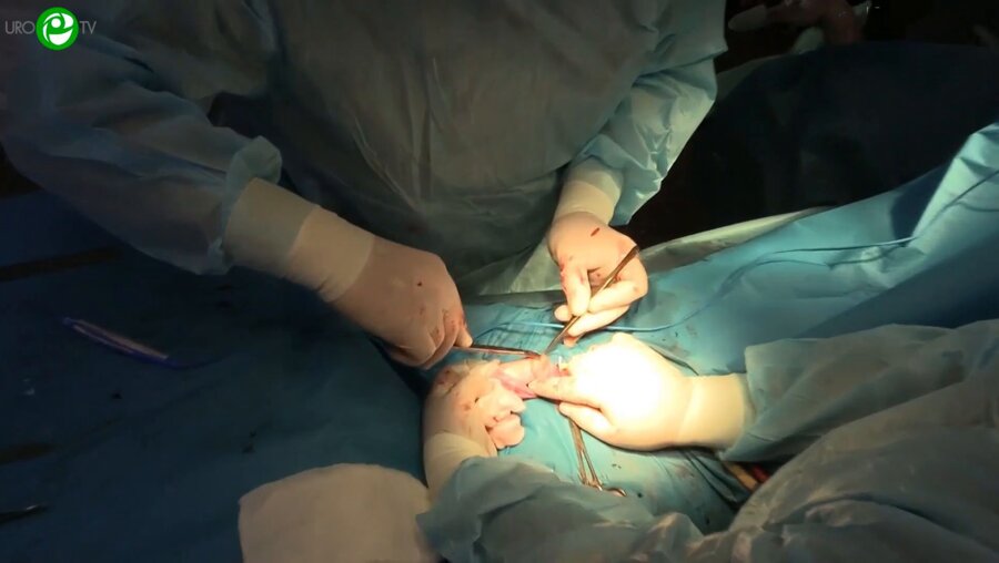 Операционная секция 6. Еркович А.А. - Заместительная корпоропластика полового члена