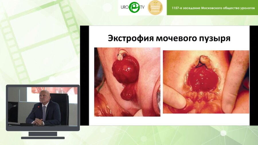 Даренков С.П., Коварский С.Л., Захаров А.И. - Коррекция удерживающего механизма континентной стомы у больных с замкнутым мочевым резервуаром