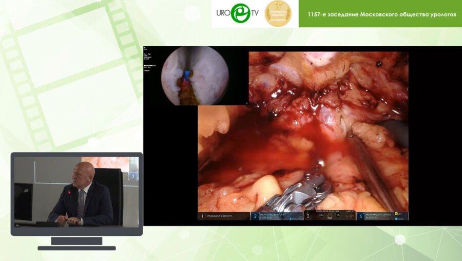 Орлов И.Н. - Робот-ассистированная YV-пластика шейки мочевого пузыря
