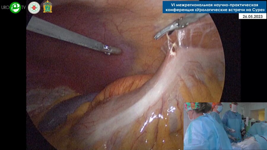 Миронов М.А. - Лапароскопическая резекция кисты почки