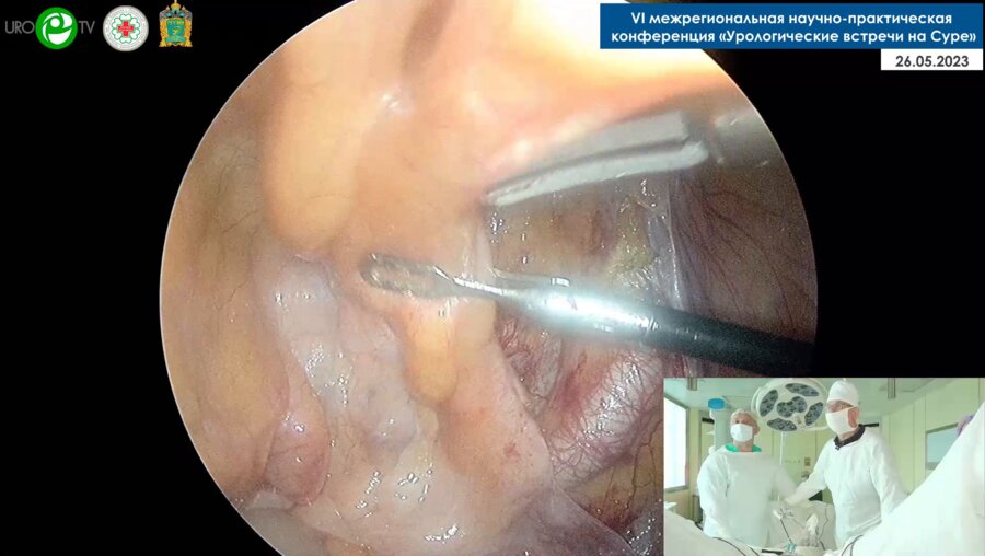 Енгалычев Ф.Ш. - Лапароскопическая нервосберегающая простатэктомия