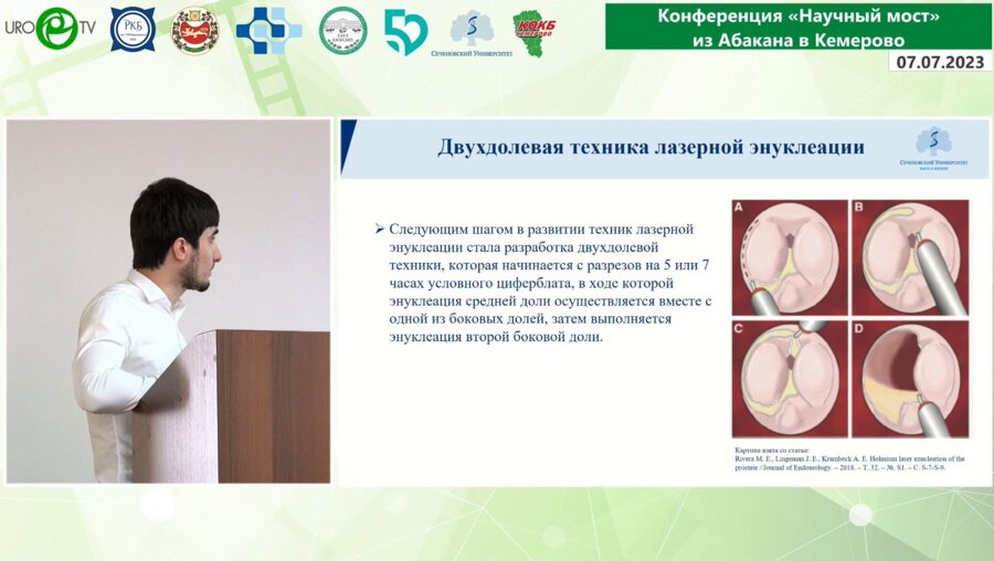 Дибиралиев Ч.Д. - Техника total en-bloc. Новая модифицированная техника лазерной энуклеации гиперплазии простаты