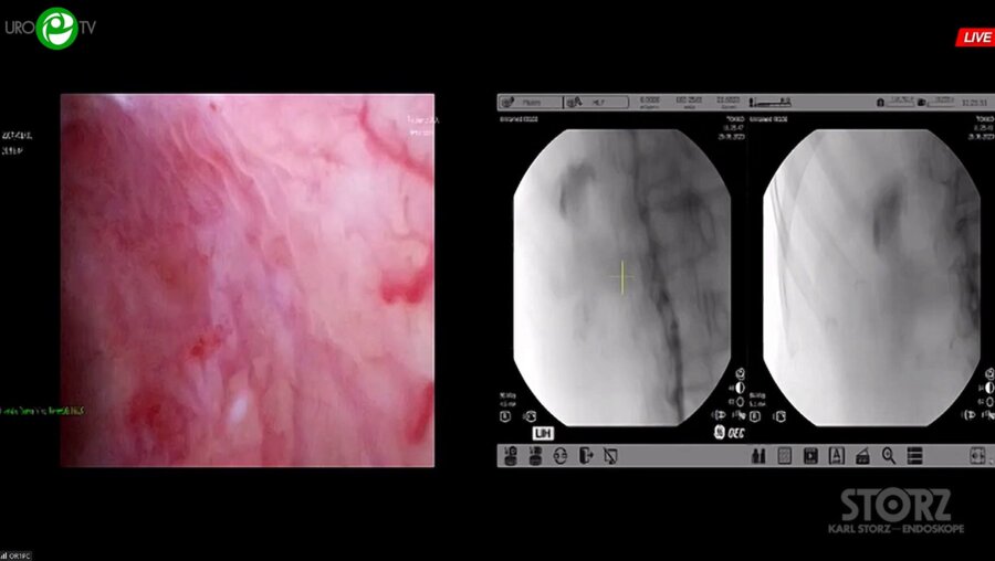 Мартов А.Г. - Комбинированная интраренальная хирургия с использованием технологии микроперк