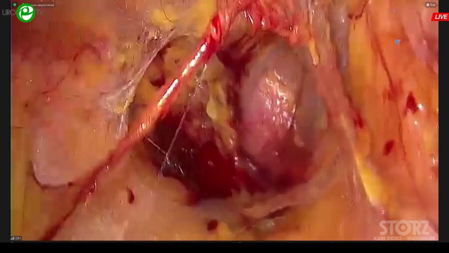 Галлямов Э.А. - Лапароскопическая простатэктомия