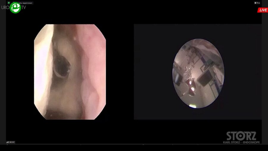 Гаджиев Н.К., Малхасян В.А. - Комбинированная интраренальная хирургия с использованием технологии миниперк