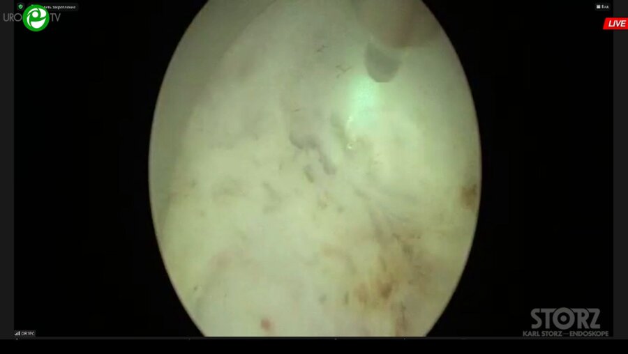 Сорокин Н.И. - Энуклеация гиперплазии простаты