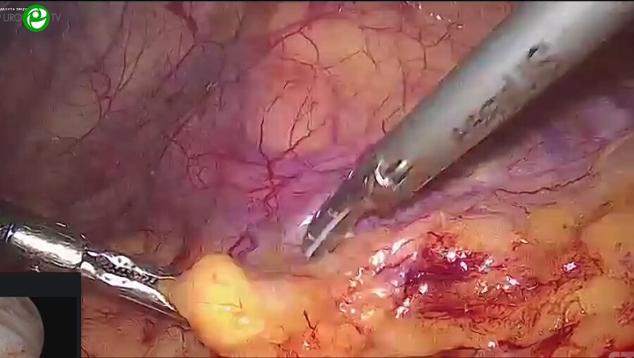 Холтобин Д.П. - Лапароскопическая пластика лоханочно-мочеточникового сегмента, каликолитоэкстракция