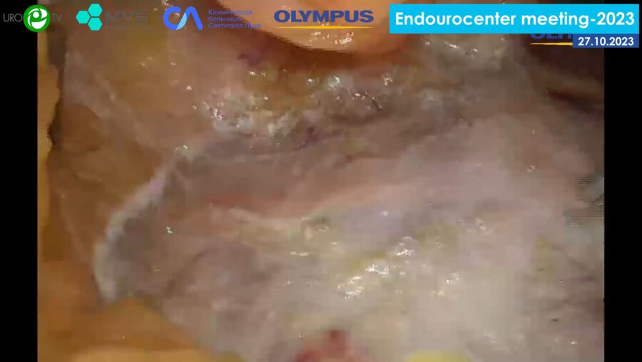 Вязовцев П.В. - Лапароскопическая резекция почки с эндоваскулярной окклюзией почечной артерии