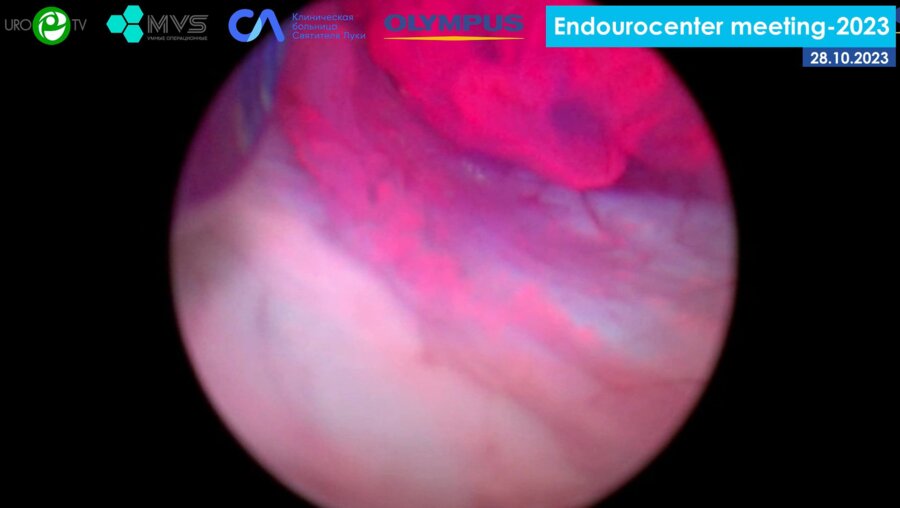Носов А.К. - ТУР стенки мочевого пузыря с визуализацией в синем цвете (BLI)_1