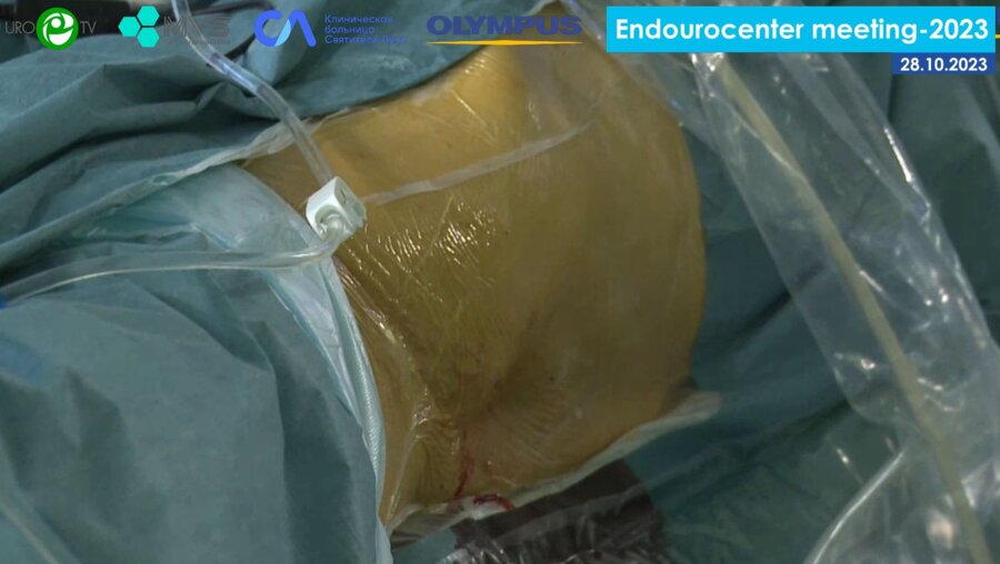 Сулейманов М.М., Пазин И.С. - Симультанная билатеральная эндоскопическая хирургия