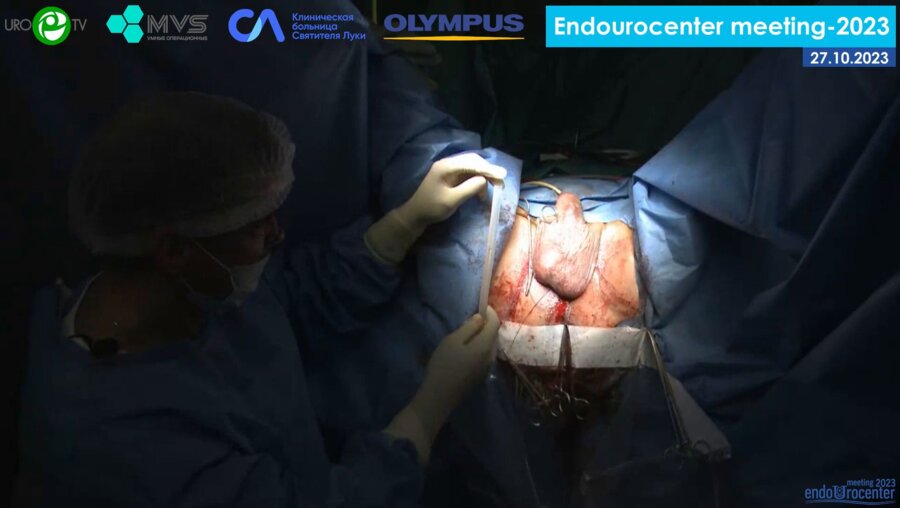 Филимонов В.Б. - Симультанная установка однокомпонентного фаллопротеза и мужского слинга Istop + протез ZSI