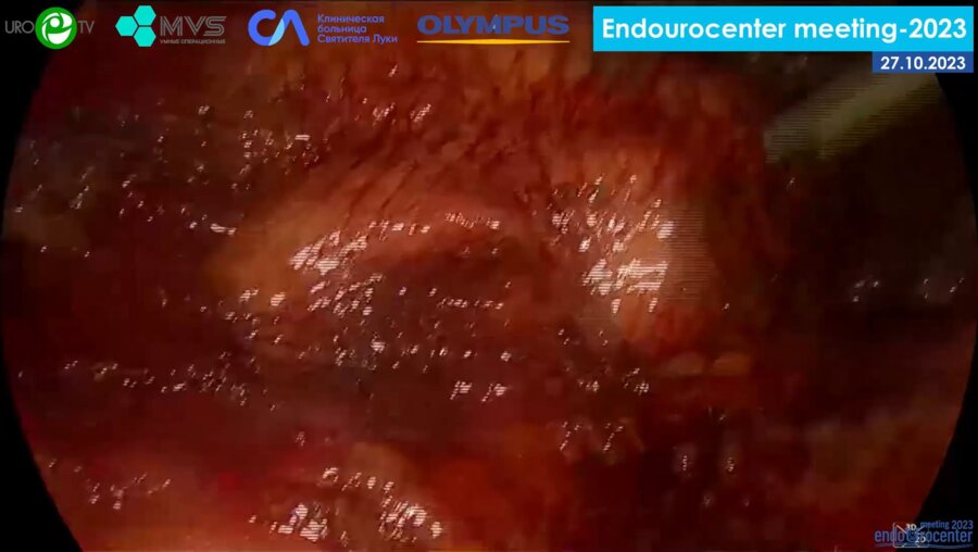 Биктимиров Р.Г. - Лапароскопическая резекция почки (с селективной ишемией и применением ICG)