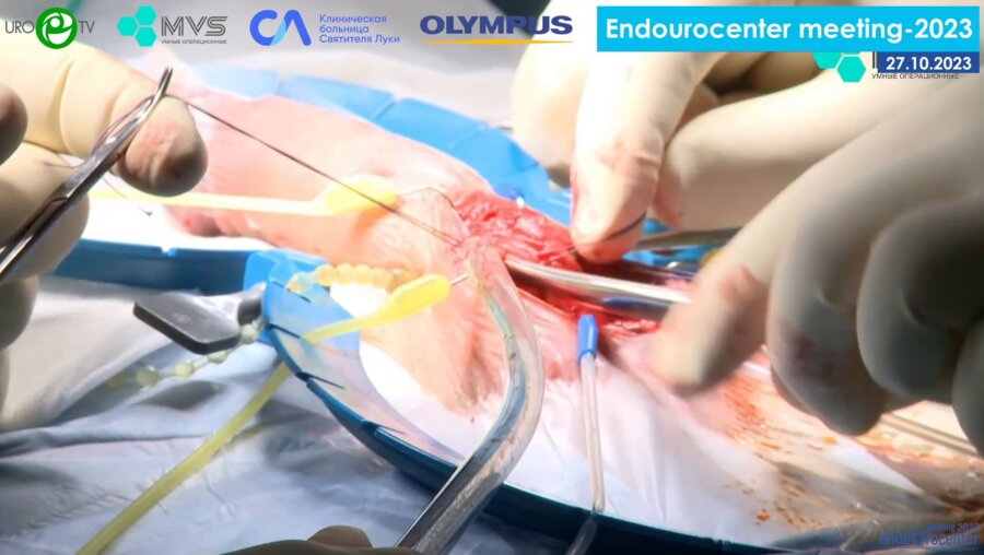 Гвасалия Б.Р. - Трехкомпонентное фаллопротезирование Boston