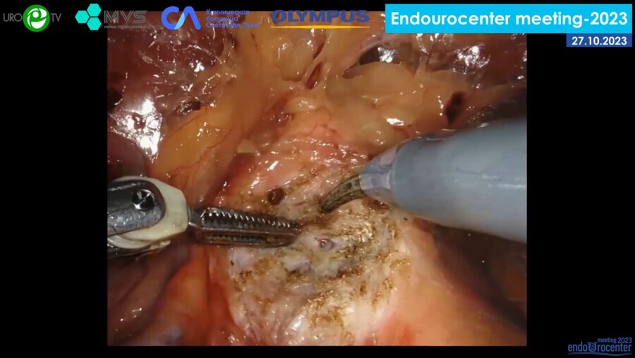 Павлов В.Н. - Робот-ассистированная нейросохраняющая радикальная простатэктомия (роботическая система da Vinci Xi)