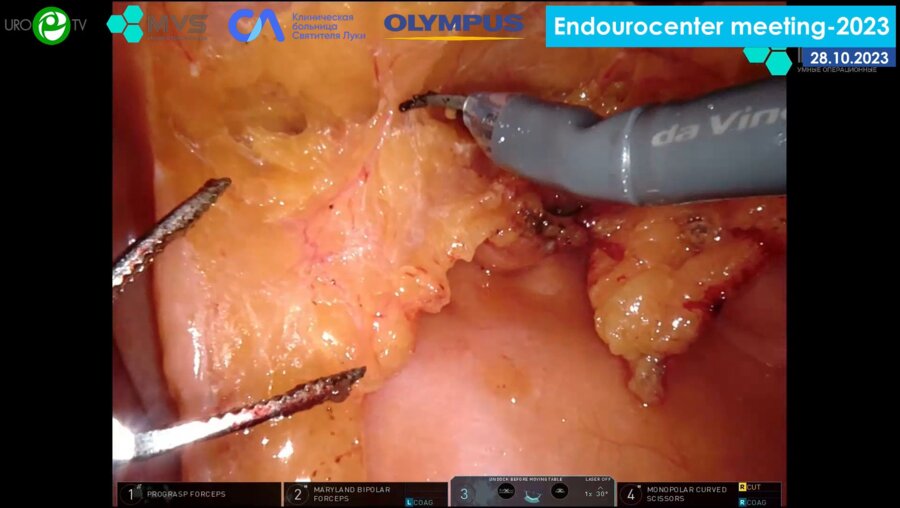 Орлов И.Н. - Робот-ассистированная YV-пластика шейки мочевого пузыря