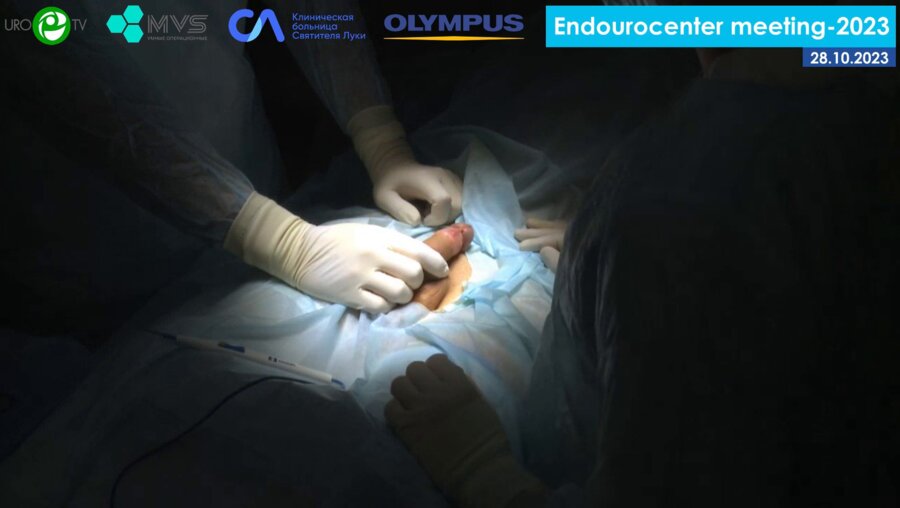 Цой А.В. - Аппаратная циркумцизия (GREENA анастомат)