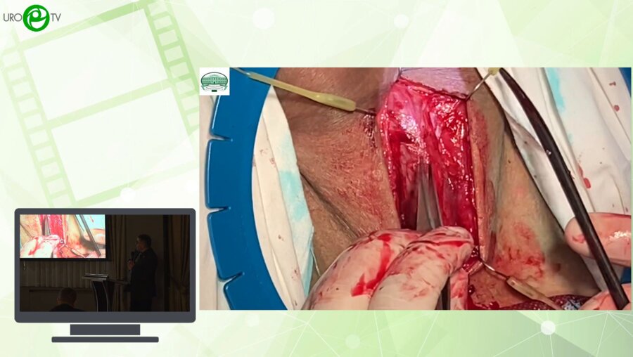 Гончаров Н.А. - Пластика коротких стриктур уретры, наш опыт