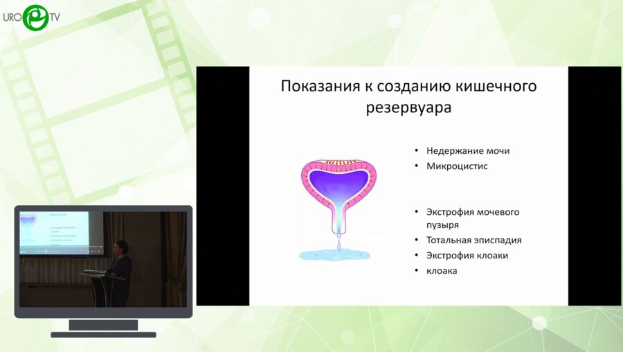 Даренков С.П., Пинчук И.С., Коварский С.Л., Захаров А.И., Петрухина Ю.В. - Артифициальный мочевой пузырь у ребенка с клоакой