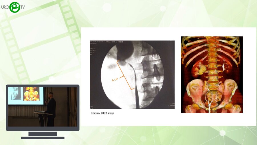 Витаев А.А. -  Робот-ассистированная аугментационная пластика лоханочно-мочеточникового сегмента и верхней трети правого мочеточника