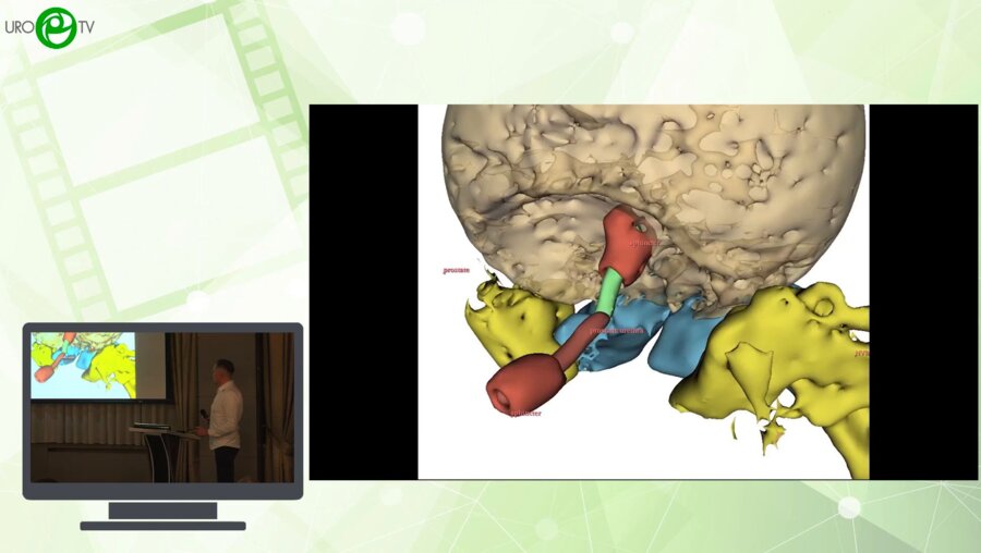 Еременко С.Н.., Еременко А.Н., Долгополов В.П.., Симонович А.В., Алиев М.А. - Робот-ассистированная радикальная простатэктомия с сохранением семенного комплекса и реконструкцией уретры