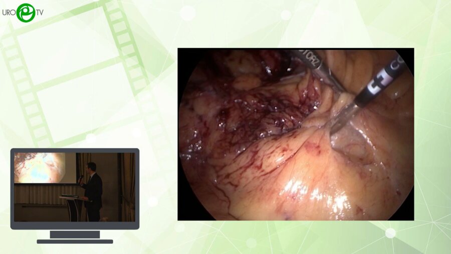 Мамаев И.Э., Ягудин Ш.Б. - Лапароскопическая пиелолитотомия при коралловидном нефролитиазе