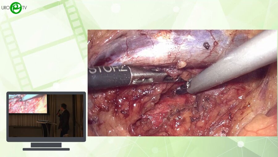 Попов А.М., Соколов А.А., Абдряхимов Э.Ф., Аниканова Е.В., Бурлаков И.Д. - Лапароскопическая резекция почки при опухоли RENAL 11