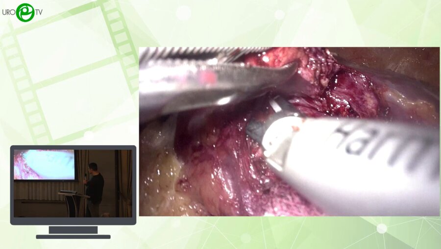 Попов А.М., Соколов А.А., Абдряхимов Э.Ф., Аниканова Е.В., Бурлаков И.Д. - По стопам учителей. Лапароскопическая хирургия "воротных" опухолей почек