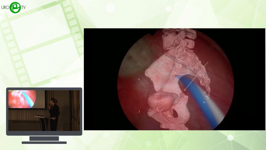 Попов С.В., Орлов И.Н., Топузов Т.М., Помешкин Е.В., Малик В.В. - Лапароскопическая фистулопластика
