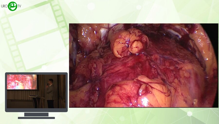 Проскоков А.А., Молчанов Ю.В., Климов Ю.А. - Лапароскопическая резекция дивертикула мочевого пузыря