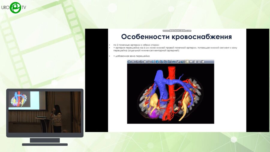 Пшихачев А.М., Сорокин Н.И., Бадмаева Е.М., Дзитиев В.К., Камалов А.А. - Лапароскопическая резекция подковообразной почки