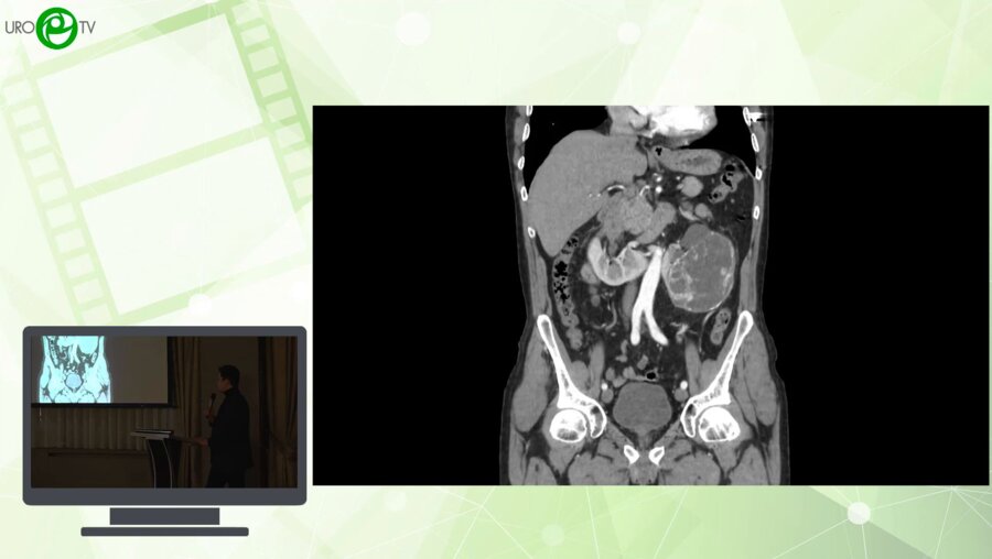 Святивода Р.В., Кудряшов О.И., Кузин Б.А. - Варианты лапароскопического доступа к почечным сосудам при крупных опухолях подковообразной почки