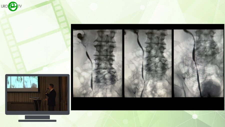 Фокин И.В. Азильгареева К.Р., Еникеев М.Э., Рапопорт Л.М. - Лапароскопическая тотальная трансмезентериальная уретероилеопластика справа с отдаленными результатами