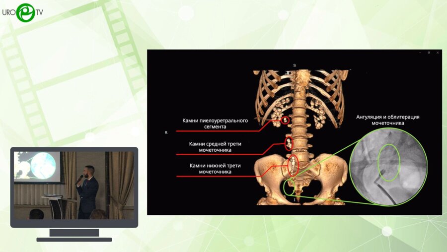 Алоян А.А. - Гибридная хирургия мочекаменной болезни