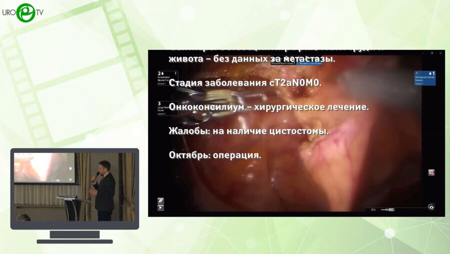 Ильин Д.М. - Робот-ассистированная радикальная простатэктомия у пациента с цистостомой