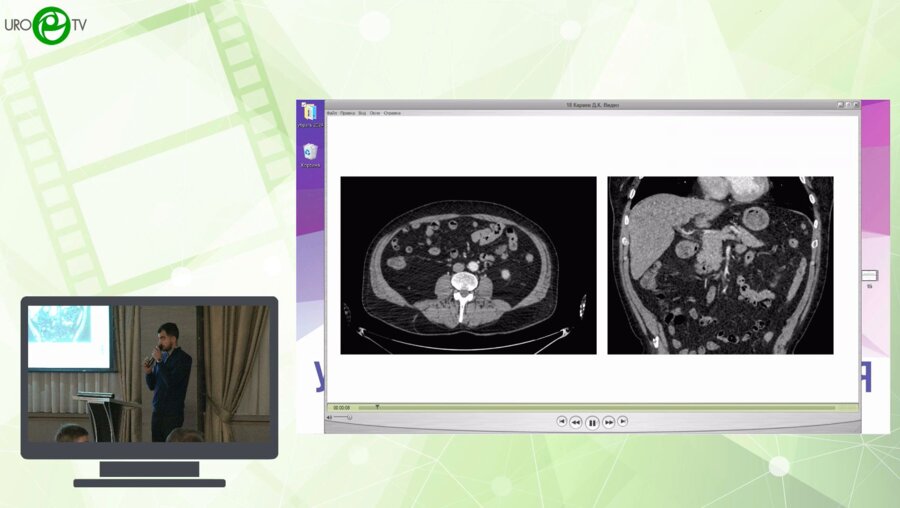 Караев Д.К., Саакян А.А., Фатихов Р.Р. - Лапароскопическая энуклеация опухоли левой почки RENAL 12 с использованием 3D-реконструкции