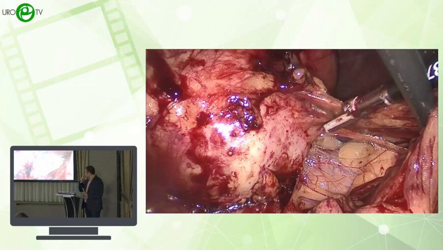 Саркисян А.Д. -  Киста почки как «рак» - лапароскопическая резекция