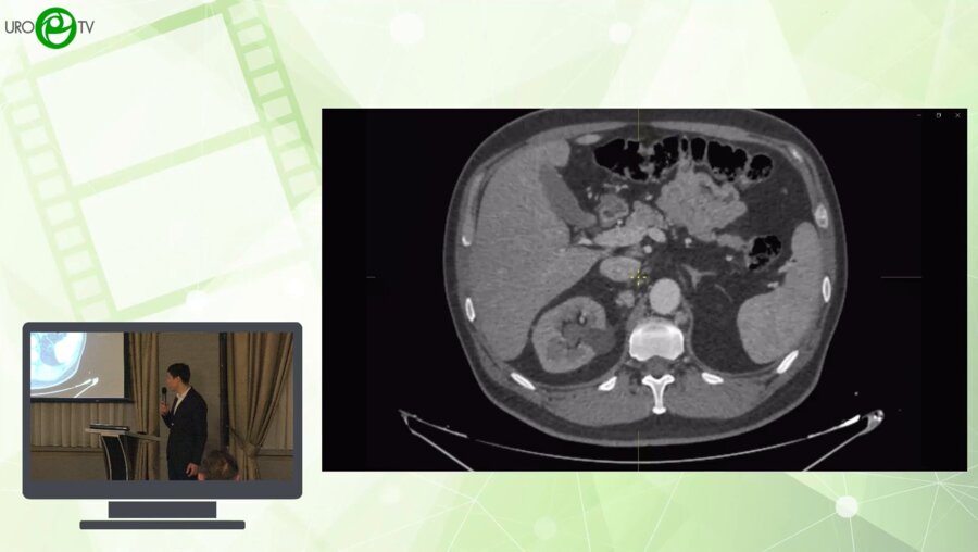 Соколов С.А. - Лапароскопичекая нефрэктомия с ретро и аортокавальной лимфаденэктомией