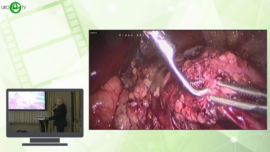 Шмыров О.С. - Особенности лапароскопического пиелоуретероанастомоза при рецидиве гидронефроза удвоенной почки у детей