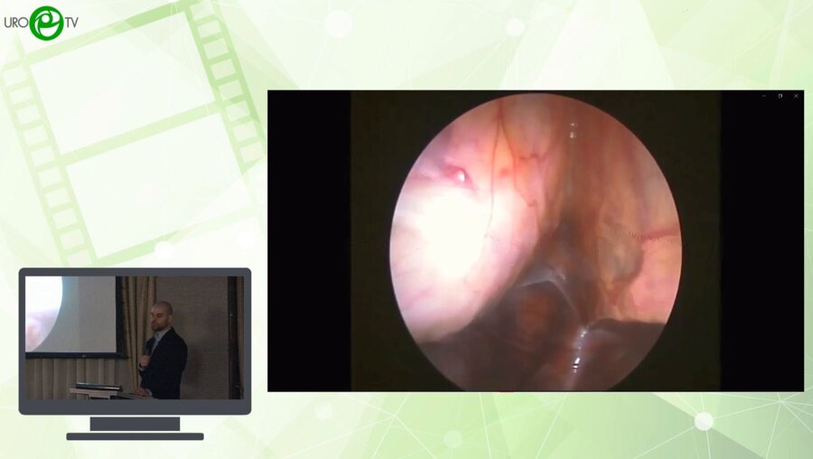 Каганцов И.М., Пелих К.И., Кондратьева Е.А. - Применение червеобразного отростка в детской урологии