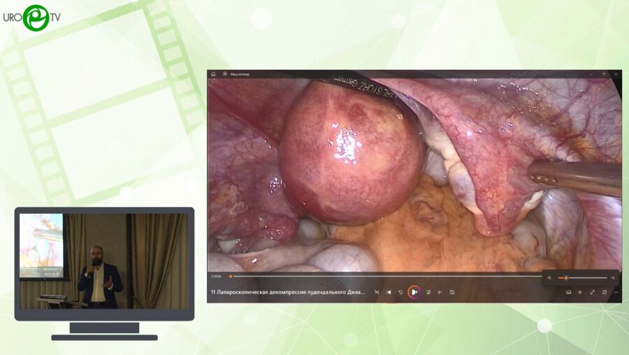 Оганес Э.Д. - Лапароскопическая декомпрессия пудендального нерва с установкой нейропротеза (процедура L.I.O.N.)